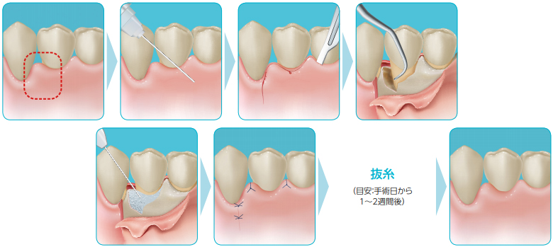 リグロスを使用した、歯周外科治療、歯周再生療法